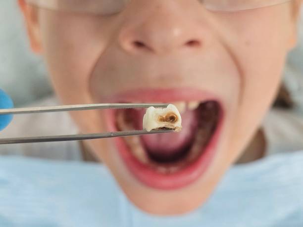 Best Emergency Dental Care for Sports Injuries in Breckenridge, MN